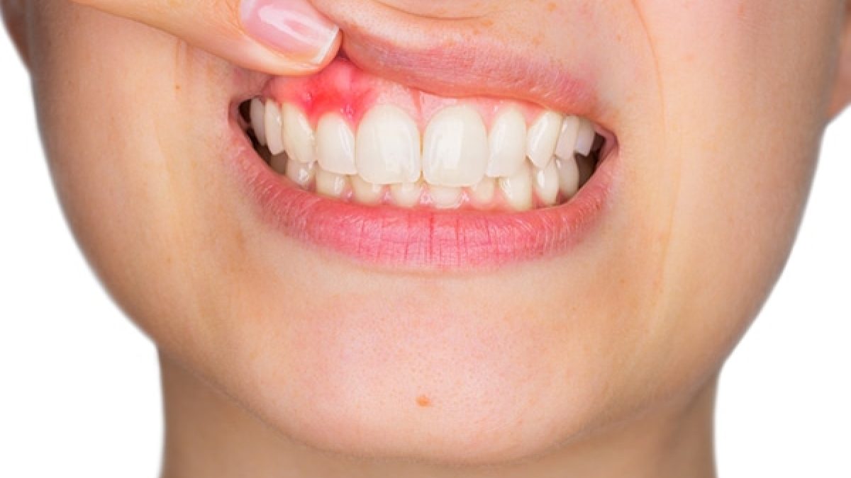 Periodontitis que es
