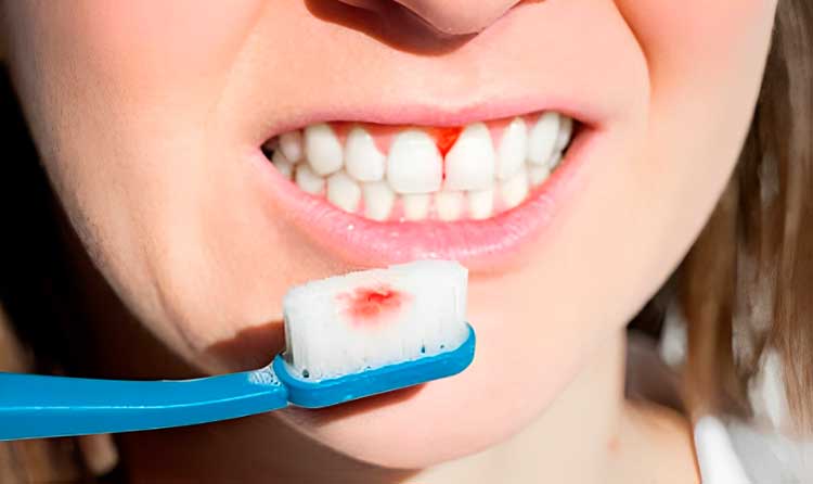 es normal sangrar al cepillar los dientes